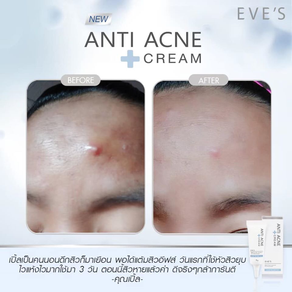 EVE'S ANTI ACNE CREAM