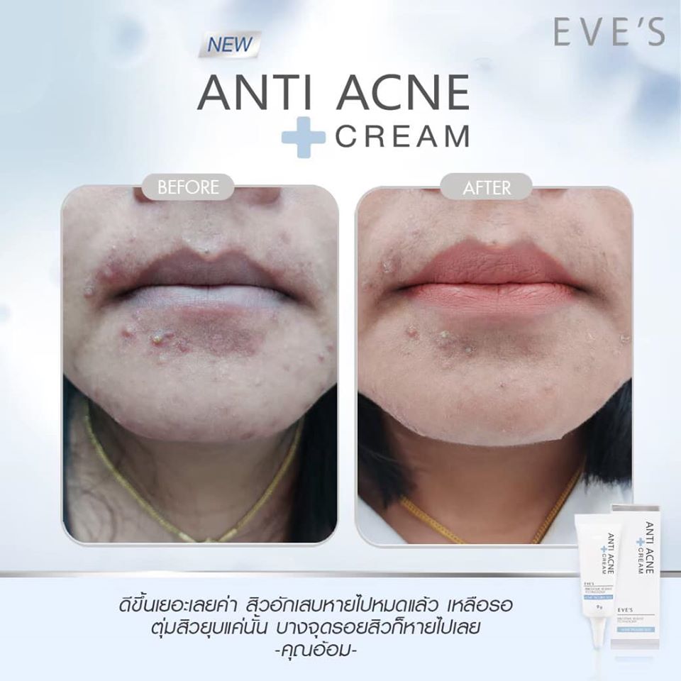 EVE'S ANTI ACNE CREAM