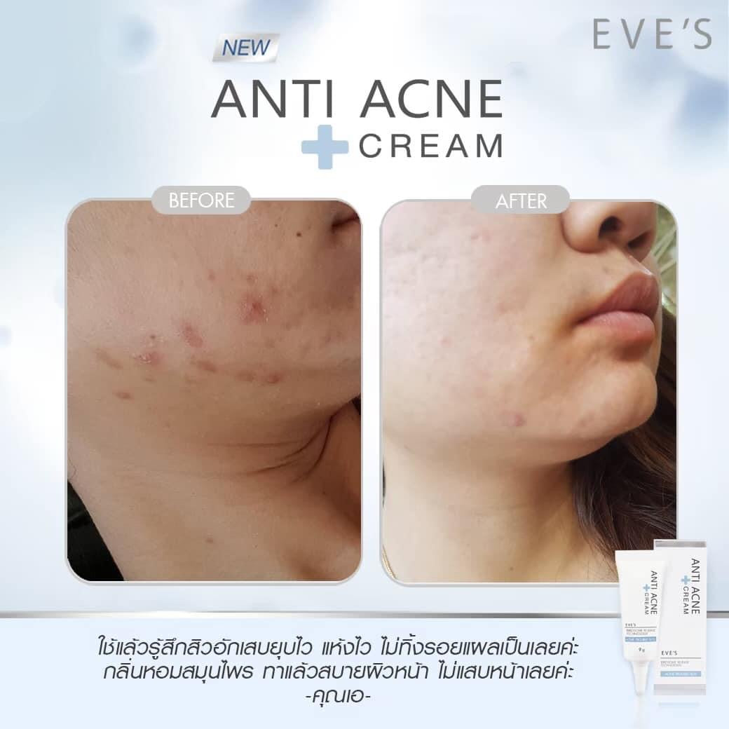 EVE'S ANTI ACNE CREAM