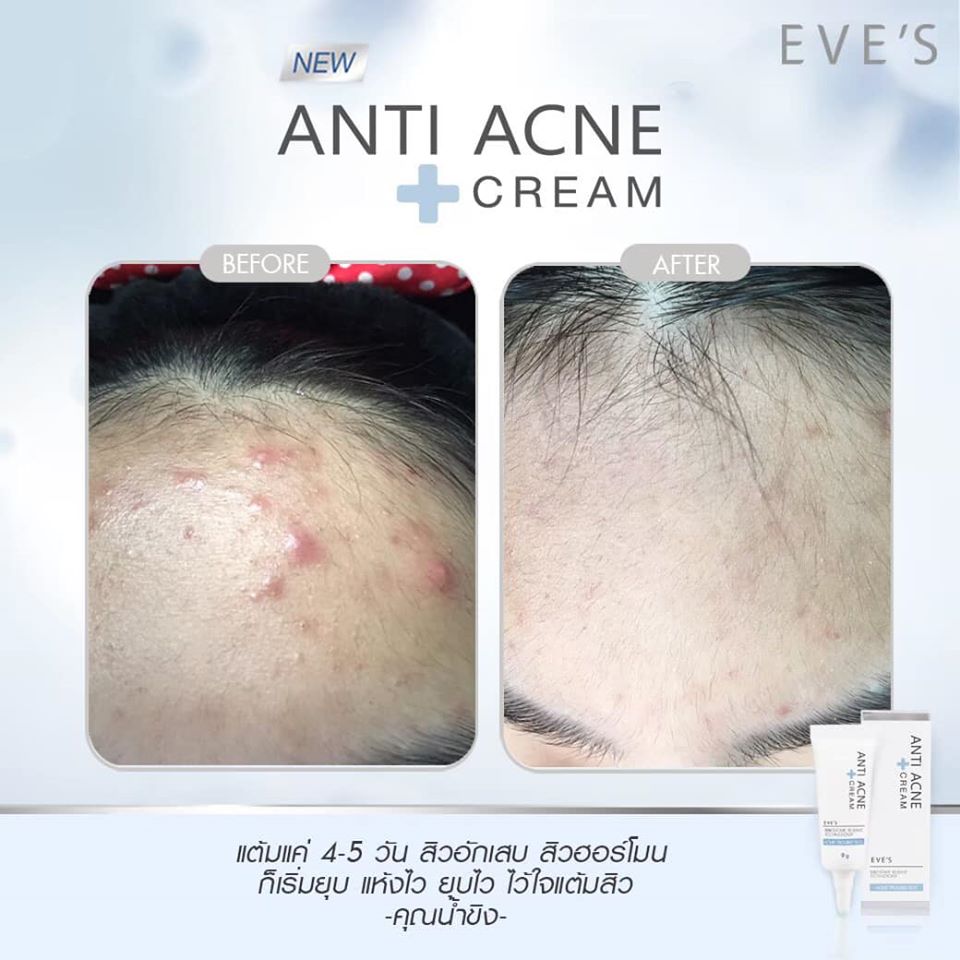 EVE'S ANTI ACNE CREAM