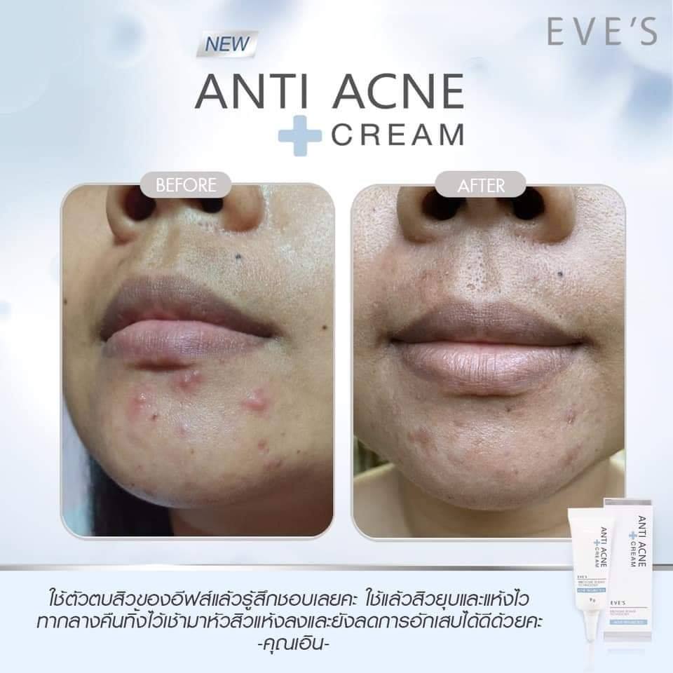 EVE'S ANTI ACNE CREAM